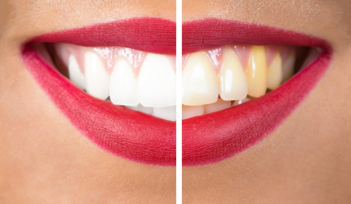 Como blanquear los dientes