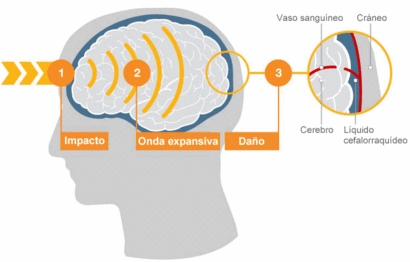 Tipos de golpes en la cabeza